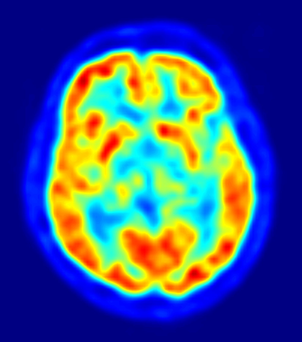 PET de un cerebro. Fuente: Wikimedia